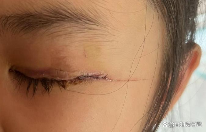 4岁女孩右眼做手术左眼也被开刀,专家说明解析_Surface58.76.58