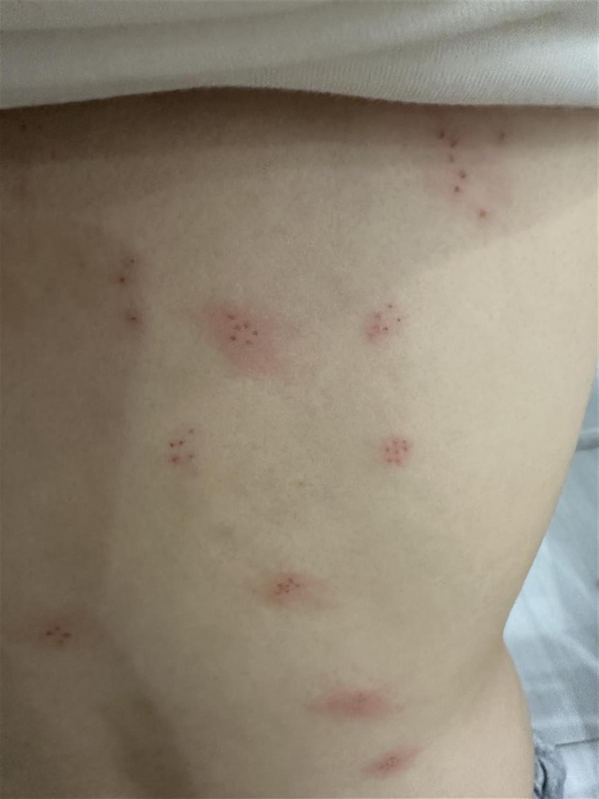 女生美容院拔罐后变紫薯精,实地应用验证数据_Advanced68.75.11
