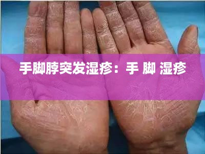 手脚脖突发湿疹：手 脚 湿疹 