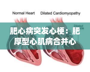 肥心病突发心梗：肥厚型心肌病合并心梗 